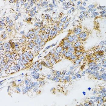 IHC-P analysis of human gastric cancer tissue using GTX65945 ProDynorphin antibody. Dilution : 1:100