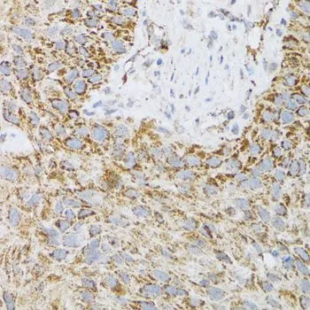 IHC-P analysis of human lung cancer tissue using GTX65945 ProDynorphin antibody. Dilution : 1:100