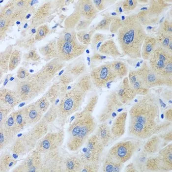 IHC-P analysis of human liver cancer tissue using GTX65958 Flavin reductase antibody. Dilution : 1:100