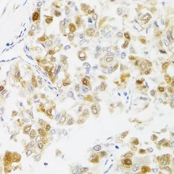 IHC-P analysis of human liver cancer tissue using GTX65990 MYO5A antibody. Dilution : 1:100