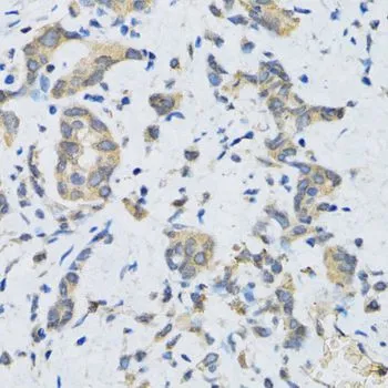 IHC-P analysis of human gastric cancer tissue using GTX65995 SLC2A13 antibody. Dilution : 1:100