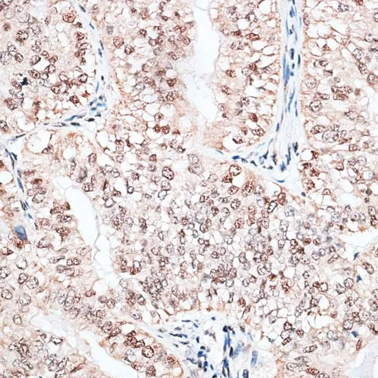 IHC-P analysis of human endometrium cancer tissue using GTX66019 RBM3 antibody. Dilution : 1:100