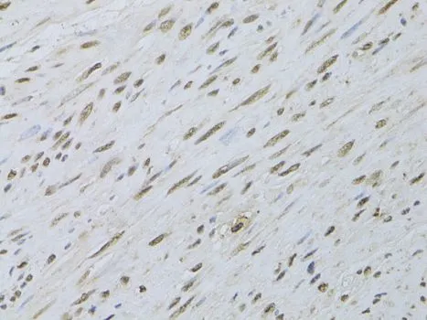 IHC-P analysis of human uterine cancer tissue using GTX66028 HDGFRP3 antibody. Dilution : 1:100