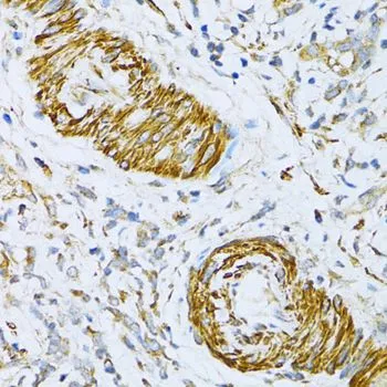 IHC-P analysis of human gastric cancer tissue using GTX66029 VAMP1 antibody. Dilution : 1:100