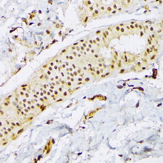 IHC-P analysis of human mammary cancer tissue using GTX66040 SFRS3 antibody. Dilution : 1:100