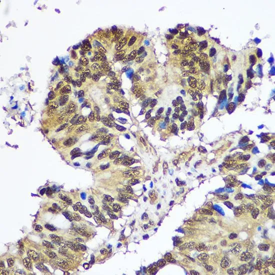 IHC-P analysis of human colon carcinoma tissue using GTX66102 UBE1 antibody. Dilution : 1:100