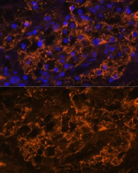 IHC-P analysis of human kidney cancer tissue using GTX66127 SLC7A9 antibody. Blue : DAPI Dilution : 1:100 IHC-P analysis of human kidney cancer tissue using GTX66127 SLC7A9 antibody. Blue : DAPI Dilution : 1:100