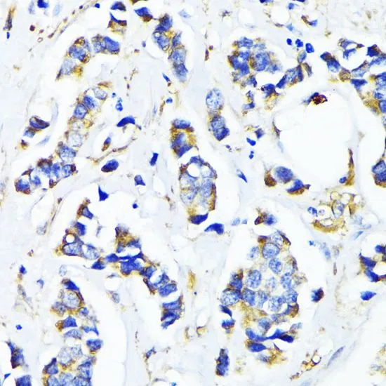 IHC-P analysis of human breast cancer tissue using GTX66181 MRPL45 antibody. Dilution : 1:100
