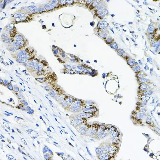 IHC-P analysis of human colon carcinoma tissue using GTX66226 GALNT3 antibody. Dilution : 1:100
