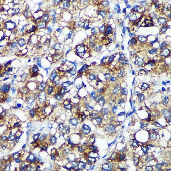 IHC-P analysis of human liver cancer tissue using GTX66340 PYCR2 antibody. Dilution : 1:100