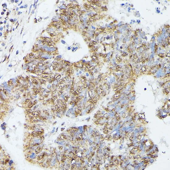 IHC-P analysis of human colon carcinoma tissue using GTX66353 KIF22 antibody. Dilution : 1:100