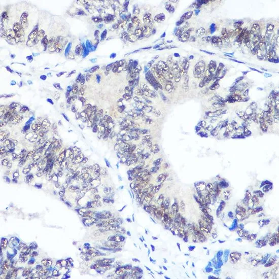 IHC-P analysis of human colon carcinoma tissue using GTX66411 SNRPB antibody. Dilution : 1:100