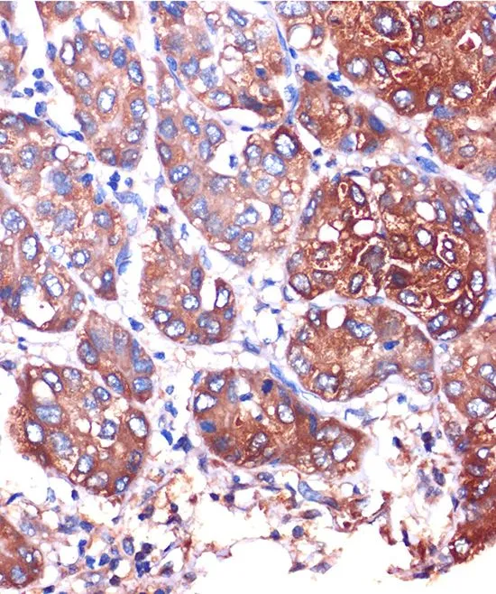 IHC-P analysis of human liver cancer tissue using GTX66442 LYPLA1 antibody. Dilution : 1:100