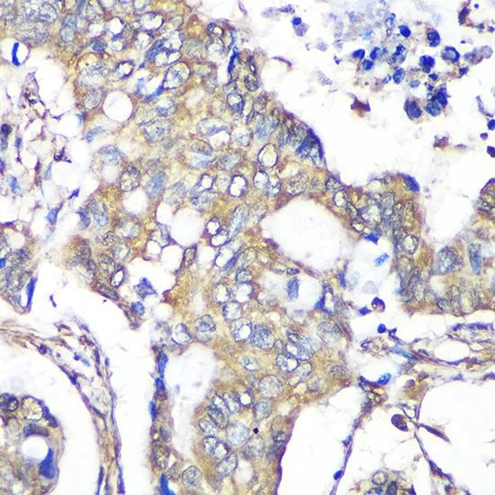 IHC-P analysis of human colon carcinoma tissue using GTX66578 TXNDC9 antibody. Dilution : 1:100