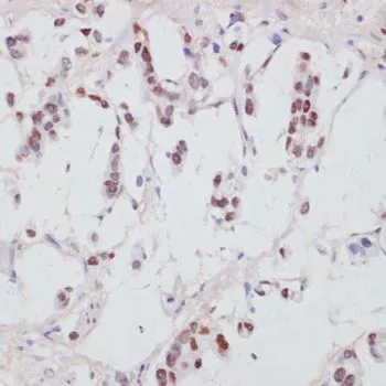 IHC-P analysis of human gastric cancer tissue using GTX66603 SRF (phospho Ser103) antibody. Dilution : 1:100