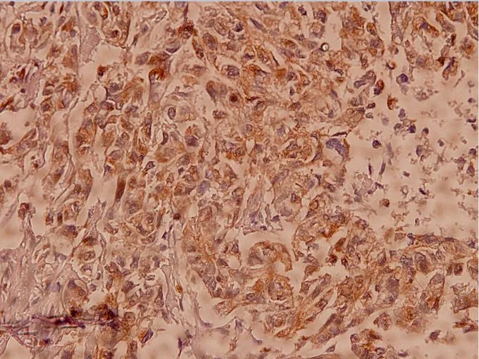IHC-P analysis of human breast carcinoma tissue using GTX66616 Claudin 7 antibody. Dilution : 1:100 IHC-P analysis of human breast carcinoma tissue using GTX66616 Claudin 7 antibody. Dilution : 1:100