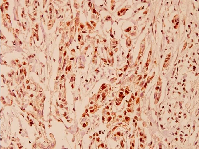 IHC-P analysis of human breast carcinoma tissue using GTX66618 Cyclin E1 antibody. Dilution : 1:100 IHC-P analysis of human breast carcinoma tissue using GTX66618 Cyclin E1 antibody. Dilution : 1:100