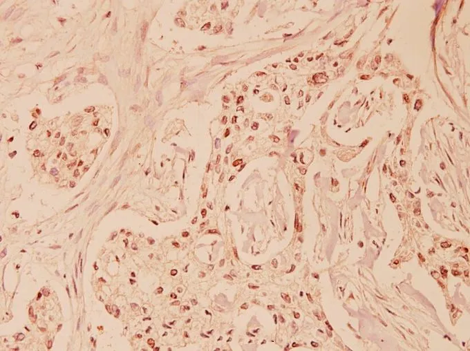 IHC-P analysis of human breast carcinoma tissue using GTX66619 Fas Ligand antibody. Dilution : 1:100 IHC-P analysis of human breast carcinoma tissue using GTX66619 Fas Ligand antibody. Dilution : 1:100