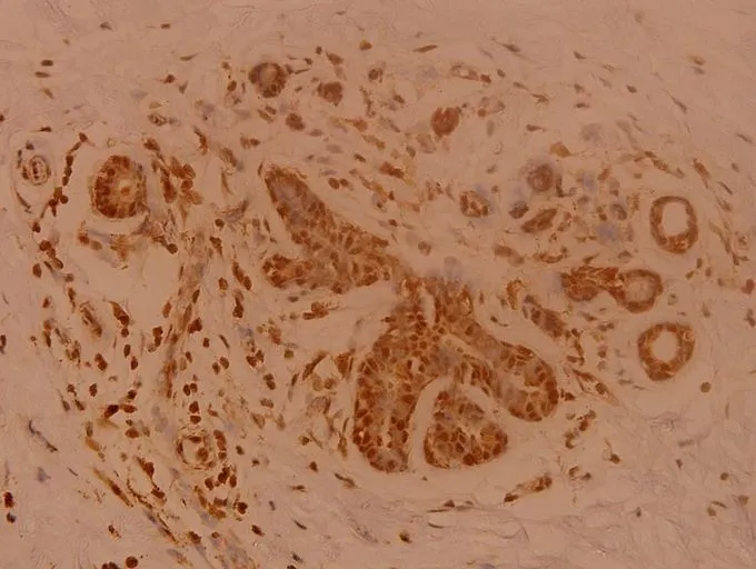 IHC-P analysis of human breast carcinoma tissue using GTX66632 SENP1 antibody. Dilution : 1:100 IHC-P analysis of human breast carcinoma tissue using GTX66632 SENP1 antibody. Dilution : 1:100