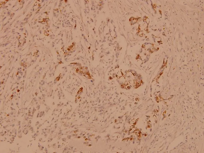 IHC-P analysis of human breast carcinoma tissue using GTX66638 alpha B Crystallin antibody. Dilution : 1:100 IHC-P analysis of human breast carcinoma tissue using GTX66638 alpha B Crystallin antibody. Dilution : 1:100