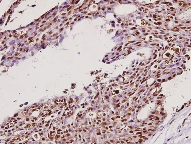 IHC-P analysis of human breast carcinoma tissue using GTX66648 IKK gamma antibody. Dilution : 1:100 IHC-P analysis of human breast carcinoma tissue using GTX66648 IKK gamma antibody. Dilution : 1:100