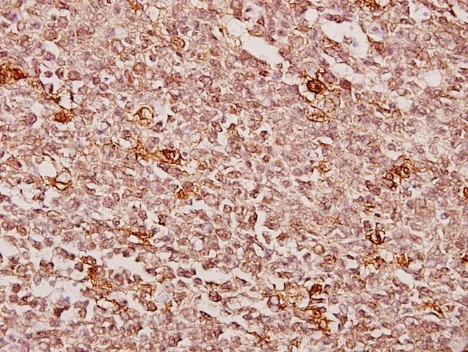 IHC-P analysis of human tonsil carcinoma tissue using GTX66650 Creatine kinase (muscle) antibody. Dilution : 1:50 IHC-P analysis of human tonsil carcinoma tissue using GTX66650 Creatine kinase (muscle) antibody. Dilution : 1:50