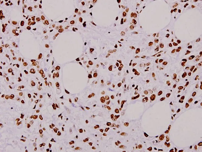 IHC-P analysis of human breast carcinoma tissue using GTX66652 hnRNP L antibody. Dilution : 1:100 IHC-P analysis of human breast carcinoma tissue using GTX66652 hnRNP L antibody. Dilution : 1:100