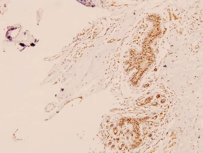 IHC-P analysis of human breast carcinoma tissue using GTX66658 MED1 antibody. Dilution : 1:100 IHC-P analysis of human breast carcinoma tissue using GTX66658 MED1 antibody. Dilution : 1:100