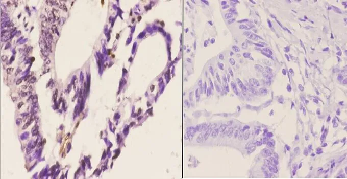 IHC-P analysis of human colon carcinoma tissue using GTX66664 CDC37 antibody. Left : Primary antibody Right : Negative control Dilution : 1:50 IHC-P analysis of human colon carcinoma tissue using GTX66664 CDC37 antibody. Left : Primary antibody Right : Negative control Dilution : 1:50