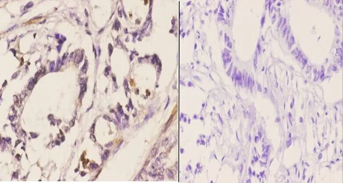 IHC-P analysis of human rectum carcinoma tissue using GTX66664 CDC37 antibody. Left : Primary antibody Right : Negative control Dilution : 1:50