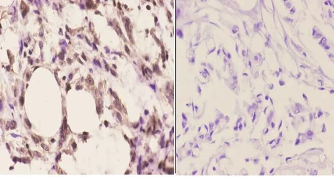 IHC-P analysis of human breast carcinoma tissue using GTX66664 CDC37 antibody. Left : Primary antibody Right : Negative control Dilution : 1:50