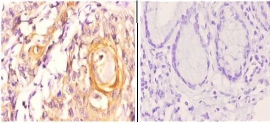 IHC-P analysis of esophageal carcinoma tissue using GTX66666 Maspin antibody. Left : Primary antibody Right : Negative control Dilution : 1:50 IHC-P analysis of esophageal carcinoma tissue using GTX66666 Maspin antibody. Left : Primary antibody Right : Negative control Dilution : 1:50
