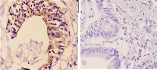 IHC-P analysis of colon carcinoma tissue using GTX66666 Maspin antibody. Left : Primary antibody Right : Negative control Dilution : 1:50