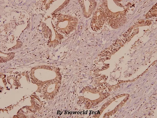 IHC-P analysis of human colorectal carcinoma tissue using GTX66682 Galectin 7 antibody. Dilution : 1:50 IHC-P analysis of human colorectal carcinoma tissue using GTX66682 Galectin 7 antibody. Dilution : 1:50