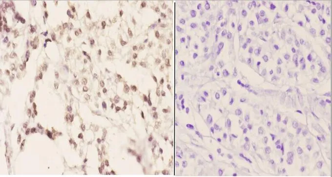 IHC-P analysis of human liver carcinoma tissue using GTX66685 SFRS3 antibody. Left : Primary antibody Right : Negative control Dilution : 1:50 IHC-P analysis of human liver carcinoma tissue using GTX66685 SFRS3 antibody. Left : Primary antibody Right : Negative control Dilution : 1:50