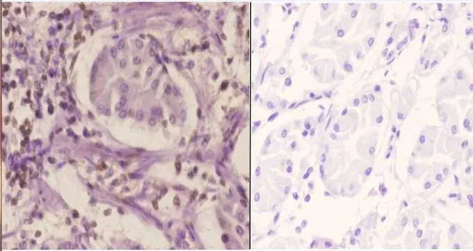 IHC-P analysis of human stomach carcinoma tissue using GTX66685 SFRS3 antibody. Left : Primary antibody Right : Negative control Dilution : 1:50