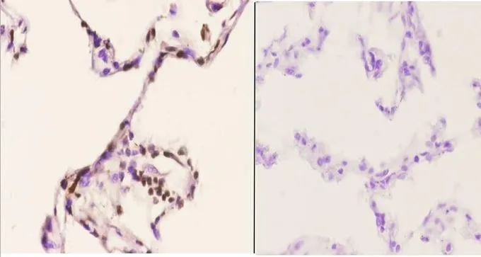 IHC-P analysis of human lung carcinoma tissue using GTX66691 PU.1 antibody. Left : Primary antibody Right : Negative control Dilution : 1:50