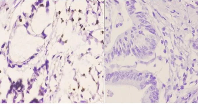 IHC-P analysis of human colon carcinoma tissue using GTX66691 PU.1 antibody. Left : Primary antibody Right : Negative control Dilution : 1:50
