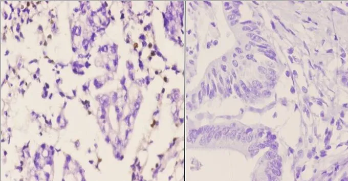 IHC-P analysis of human colon carcinoma tissue using GTX66694 PMS2 antibody. Left : Primary antibody Right : Negative control Dilution : 1:50