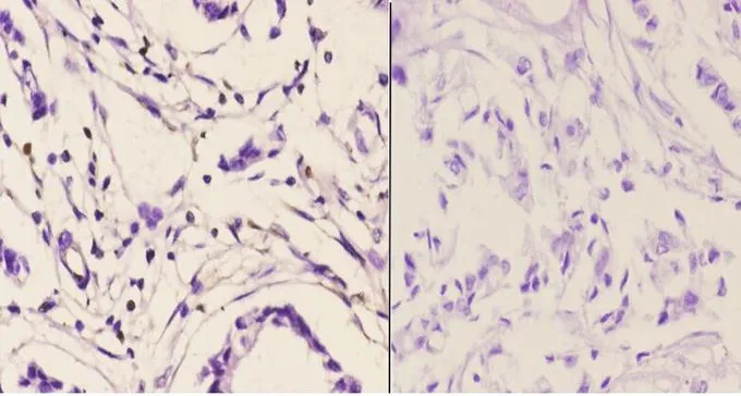 IHC-P analysis of human breast carcinoma tissue using GTX66694 PMS2 antibody. Left : Primary antibody Right : Negative control Dilution : 1:50
