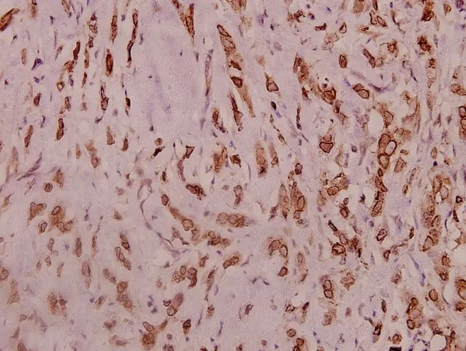 IHC-P analysis of human breast carcinoma tissue using GTX66721 Nav1.2 antibody. Dilution : 1:100 IHC-P analysis of human breast carcinoma tissue using GTX66721 Nav1.2 antibody. Dilution : 1:100