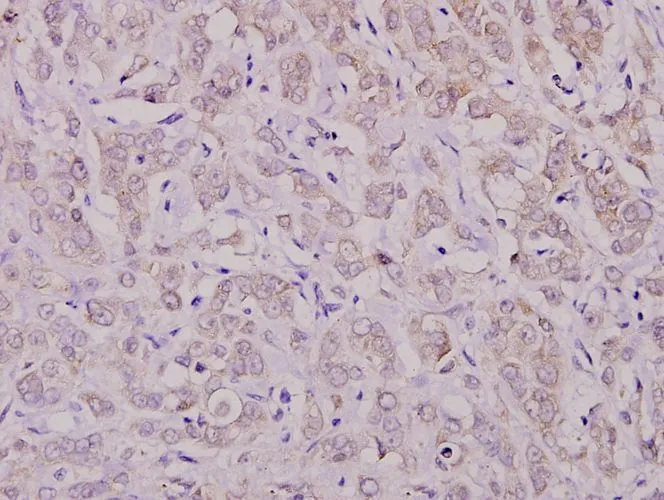 IHC-P analysis of human breast carcinoma tissue using GTX66730 PKC zeta (phospho Thr410) antibody. Dilution : 1:100