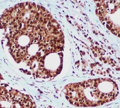 IHC-P analysis of prostate cancer tissue using GTX66845 RAD23B antibody [5H1]. Antigen retrieval : citrate buffer (pH 6.0)