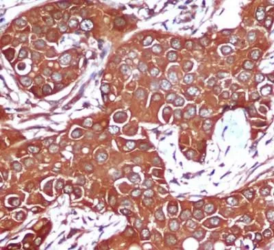 IHC-P analysis of breast cancer tissue using GTX66847 AMPK beta 1 antibody [1A7]. Antigen retrieval : citrate buffer (pH 6.0)