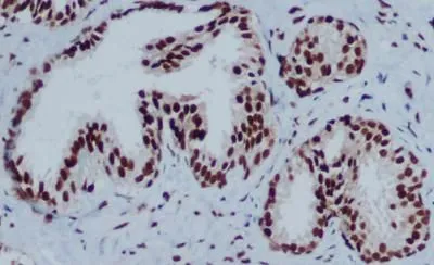 IHC-P analysis of prostate cancer tissue using GTX66848 HP1 gamma antibody [5G10]. Antigen retrieval : citrate buffer (pH 6.0)