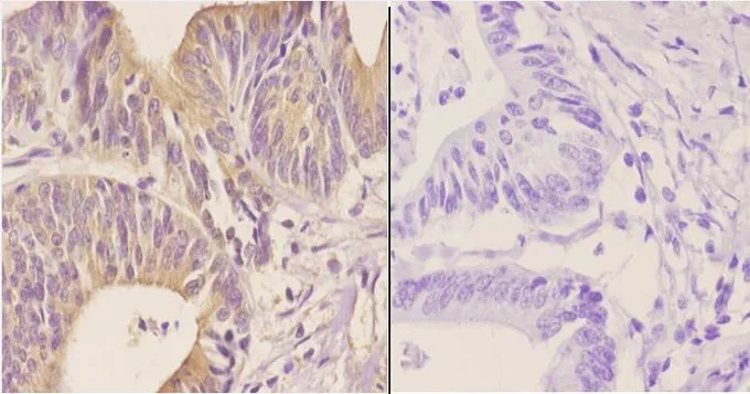 IHC-P analysis of human colon carcinoma tissue using GTX66870 TWEAK antibody. Left : Primary antibody Right : Negative control Dilution : 1:50 IHC-P analysis of human colon carcinoma tissue using GTX66870 TWEAK antibody. Left : Primary antibody Right : Negative control Dilution : 1:50