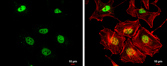 Rad50 antibody [13B3] detects Rad50 protein at nucleus by immunohistochemical analysis. Sample: Paraffin-embedded human lung cancer. Rad50 stained by Rad50 antibody [13B3] (GTX70228) diluted at 1:100. Antigen Retrieval: Citrate buffer,pH 6.0,15 min