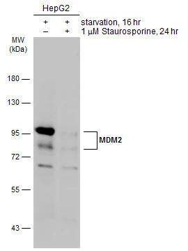 IHC-P analysis of human breast carcinoma tissue using GTX70278 MDM2 antibody [SMP14].