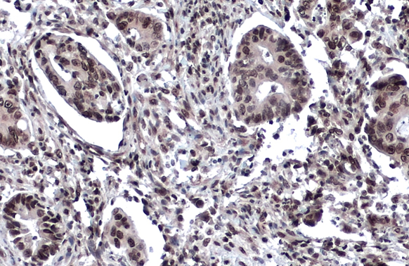 53BP1 antibody detects 53BP1 protein at nucleus by immunohistochemical analysis. Sample: Paraffin-embedded human colon cancer. 53BP1 stained by 53BP1 antibody (GTX70310) diluted at 1:4000. Antigen Retrieval: Citrate buffer, pH 6.0, 15 min 53BP1 antibody detects 53BP1 protein at nucleus by immunohistochemical analysis. Sample: Paraffin-embedded human colon cancer. 53BP1 stained by 53BP1 antibody (GTX70310) diluted at 1:4000. Antigen Retrieval: Citrate buffer, pH 6.0, 15 min
