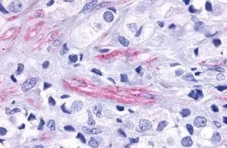 Colon carcinoma,Neoplastic cells